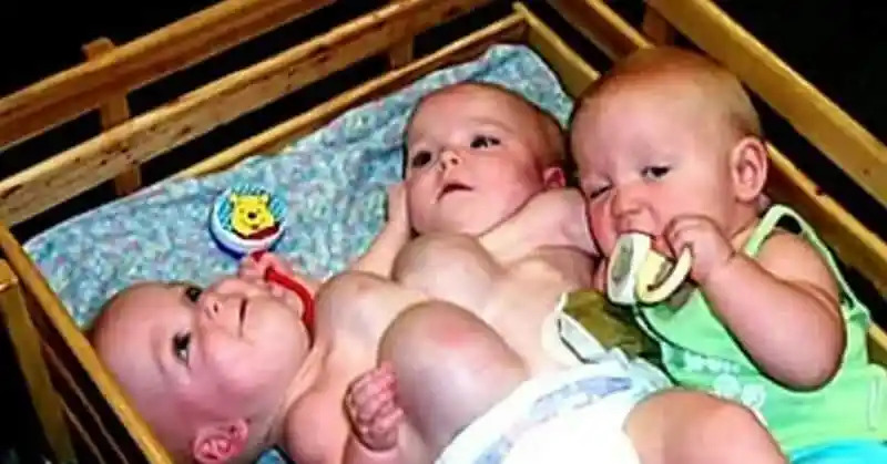 Once conjoined triplets, now 17 years old